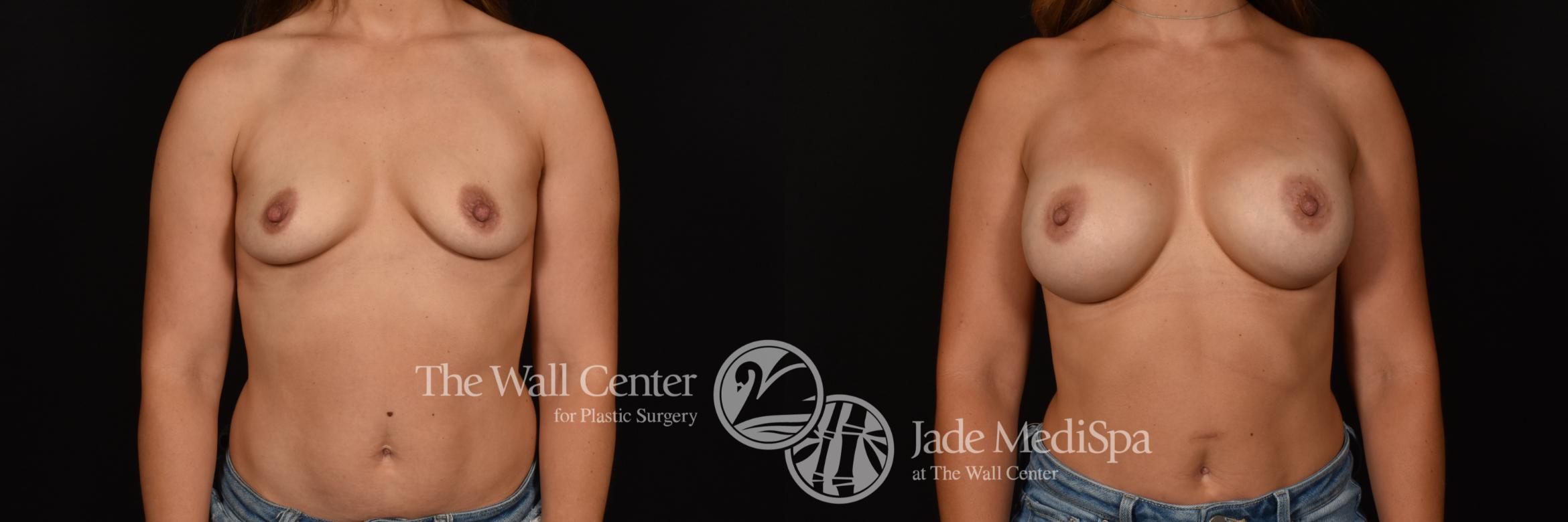 Before & After Breast Augmentation Case 1156 Front View in Shreveport, LA
