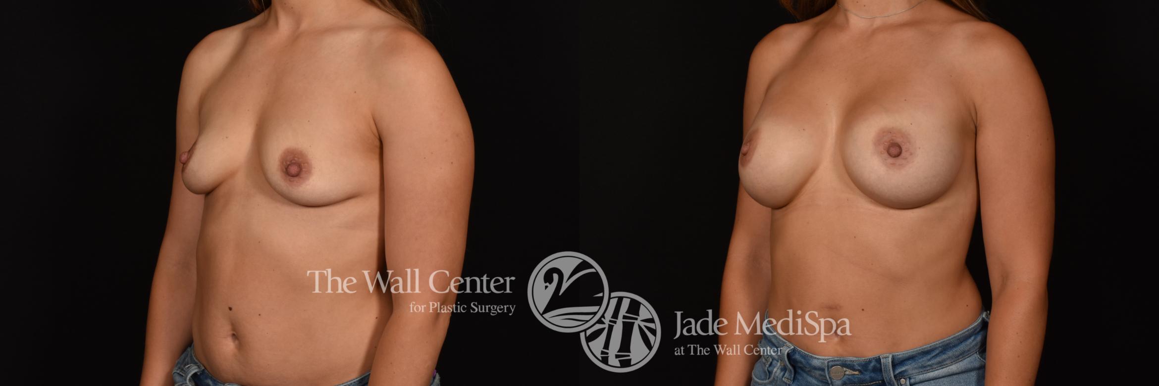 Before & After Breast Augmentation Case 1156 Left Oblique View in Shreveport, LA