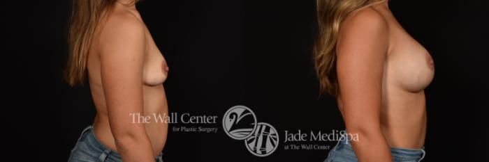 Before & After Breast Augmentation Case 1156 Right Side View in Shreveport, LA