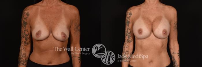 Before & After Breast Augmentation Case 1159 Front View in Shreveport, LA