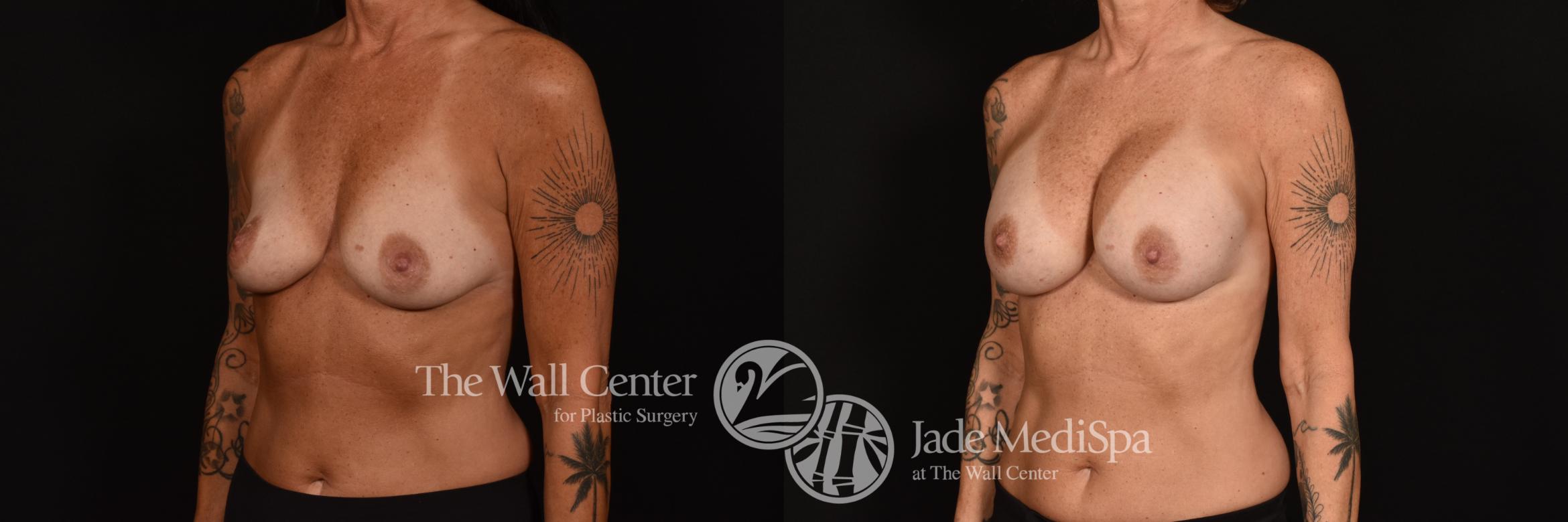Before & After Breast Augmentation Case 1159 Left Oblique View in Shreveport, LA