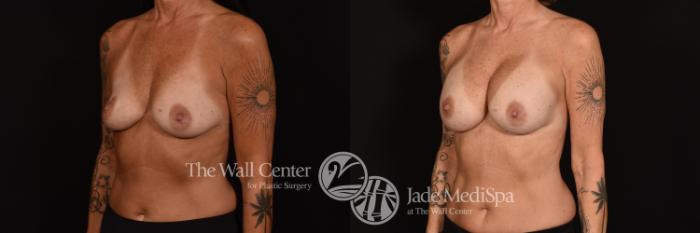 Before & After Breast Augmentation Case 1159 Left Oblique View in Shreveport, LA