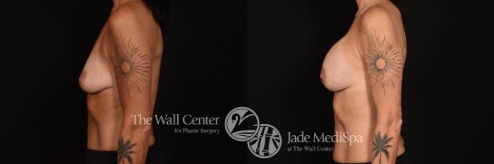 Before & After Breast Augmentation Case 1159 Left Side View in Shreveport, LA