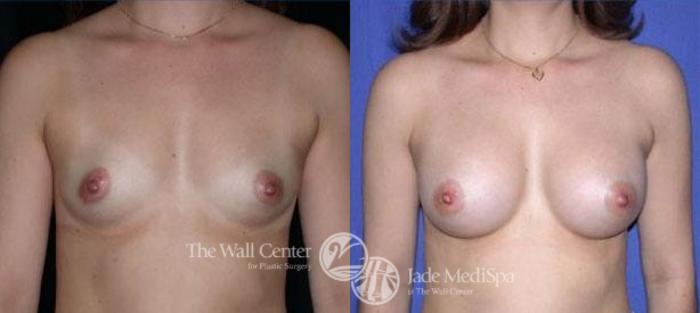 Before & After Breast Augmentation Case 116 View #1 View in Shreveport, LA