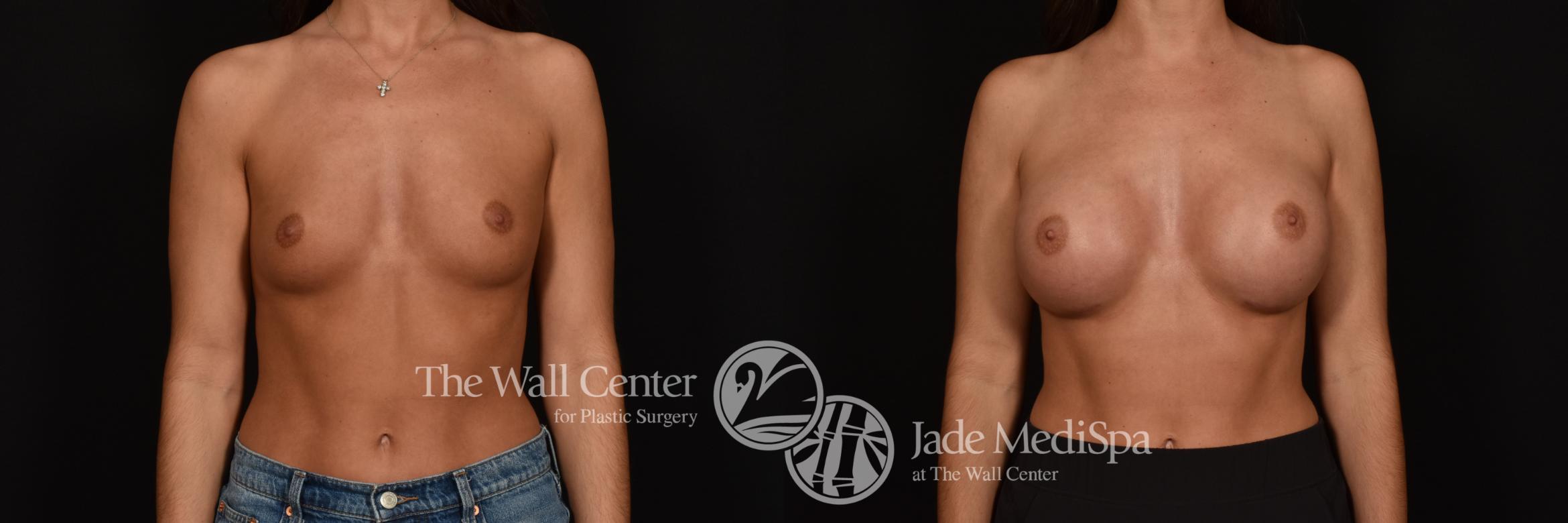 Before & After Breast Augmentation Case 1160 Front View in Shreveport, LA