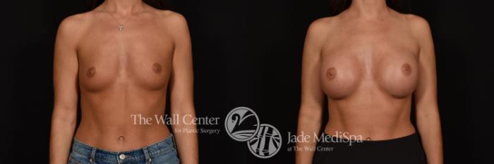 Before & After Breast Augmentation Case 1160 Front View in Shreveport, LA