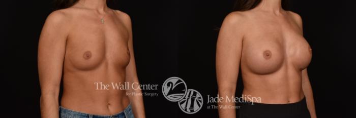 Before & After Breast Augmentation Case 1160 Right Oblique View in Shreveport, LA