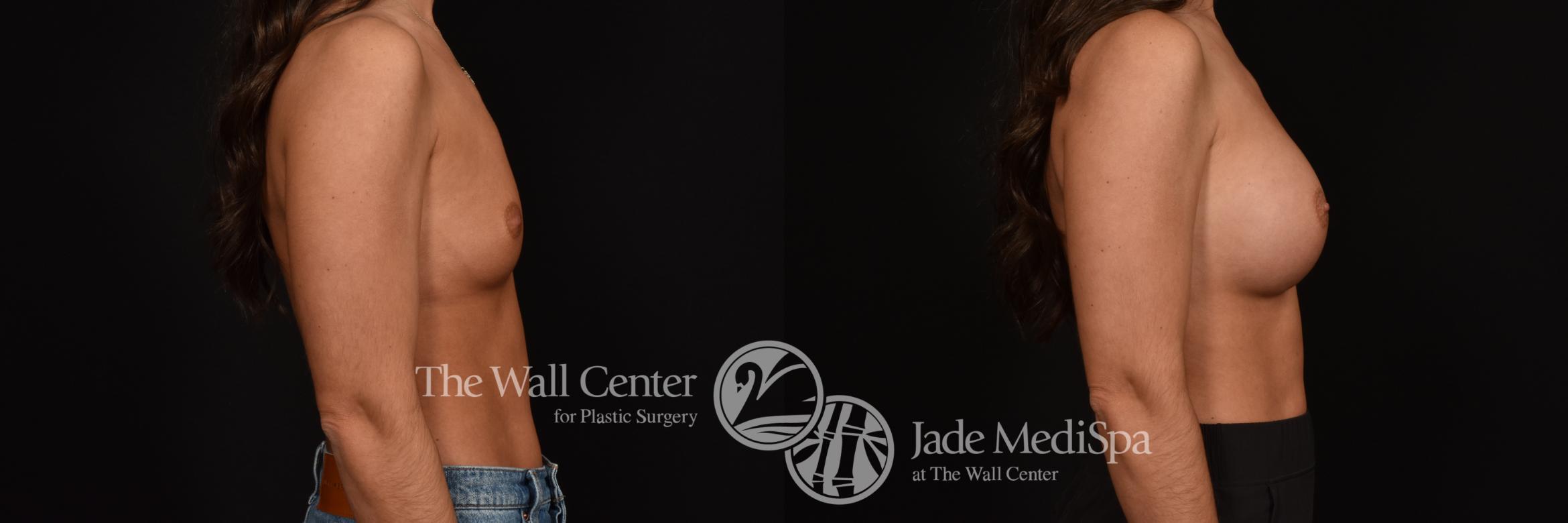 Before & After Breast Augmentation Case 1160 Right Side View in Shreveport, LA