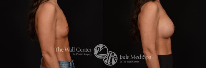 Before & After Breast Augmentation Case 1160 Right Side View in Shreveport, LA