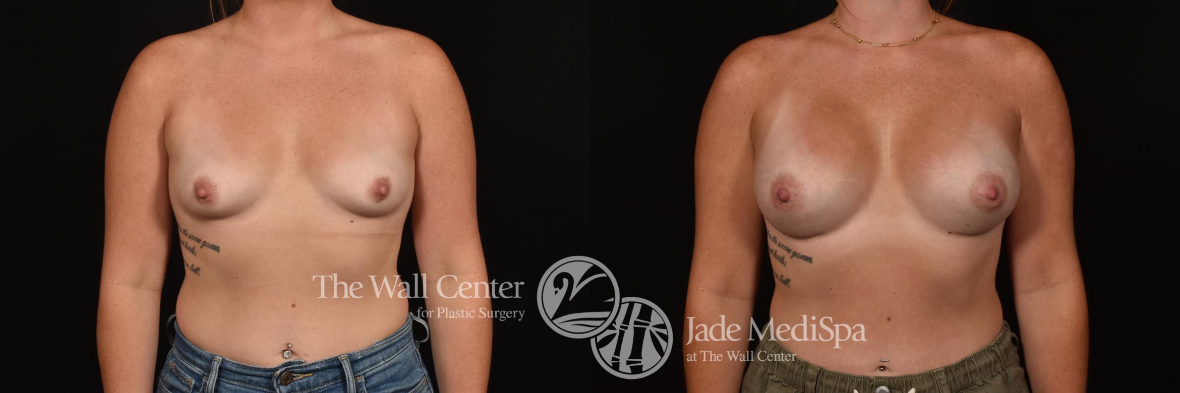 Before & After Breast Augmentation Case 1161 Front View in Shreveport, LA