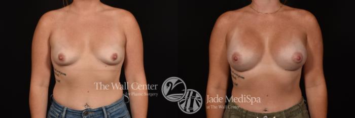 Before & After Breast Augmentation Case 1161 Front View in Shreveport, LA