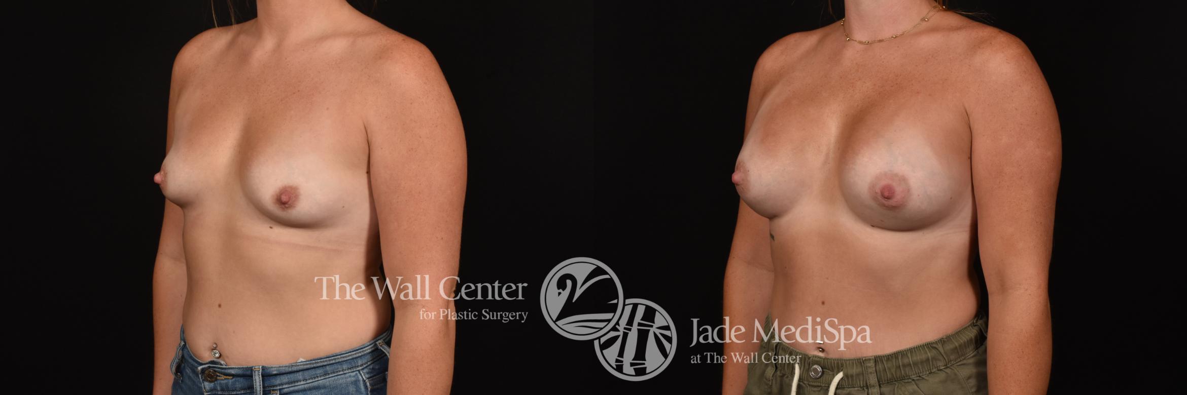 Before & After Breast Augmentation Case 1161 Left Oblique View in Shreveport, LA