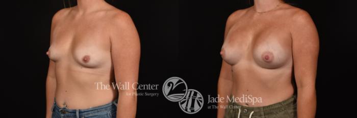 Before & After Breast Augmentation Case 1161 Left Oblique View in Shreveport, LA