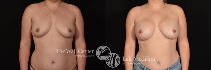 Before & After Breast Augmentation Case 1165 Front View in Shreveport, LA