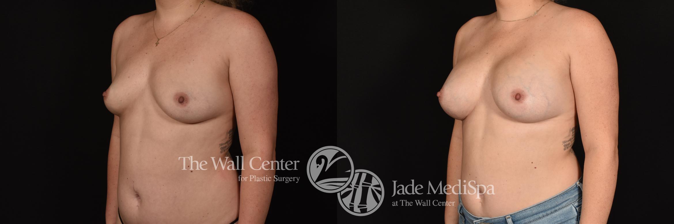 Before & After Breast Augmentation Case 1165 Left Oblique View in Shreveport, LA