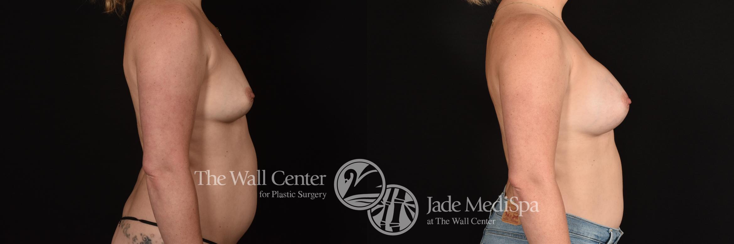 Before & After Breast Augmentation Case 1165 Right Side View in Shreveport, LA