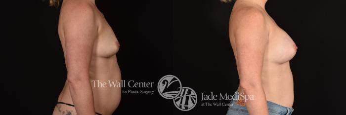 Before & After Breast Augmentation Case 1165 Right Side View in Shreveport, LA