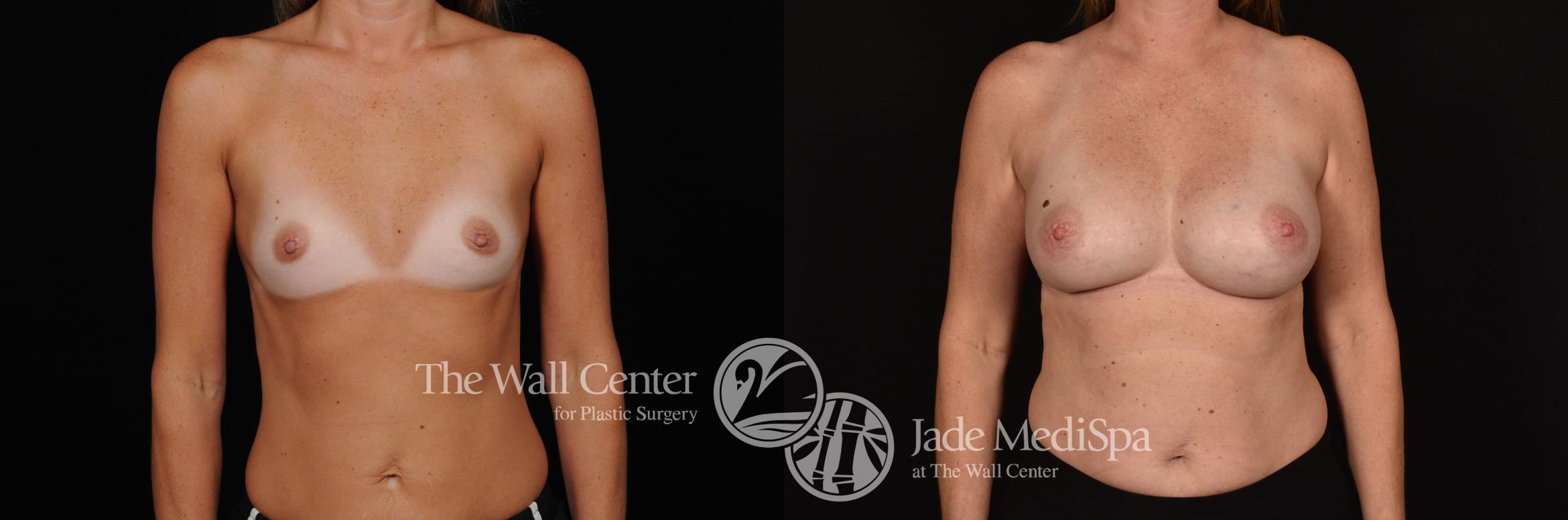 Before & After Breast Augmentation Case 1169 Front View in Shreveport, LA