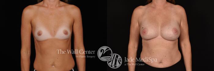Before & After Breast Augmentation Case 1169 Front View in Shreveport, LA