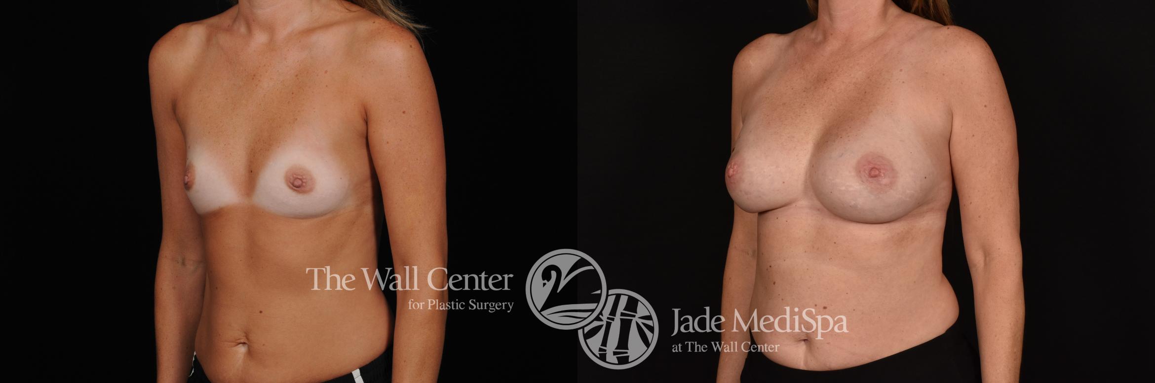 Before & After Breast Augmentation Case 1169 Left Oblique View in Shreveport, LA