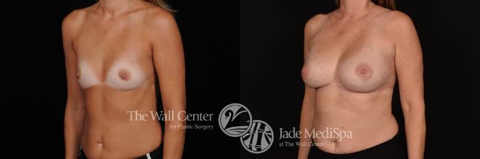 Before & After Breast Augmentation Case 1169 Left Oblique View in Shreveport, LA