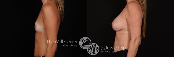 Before & After Breast Augmentation Case 1169 Left Side View in Shreveport, LA