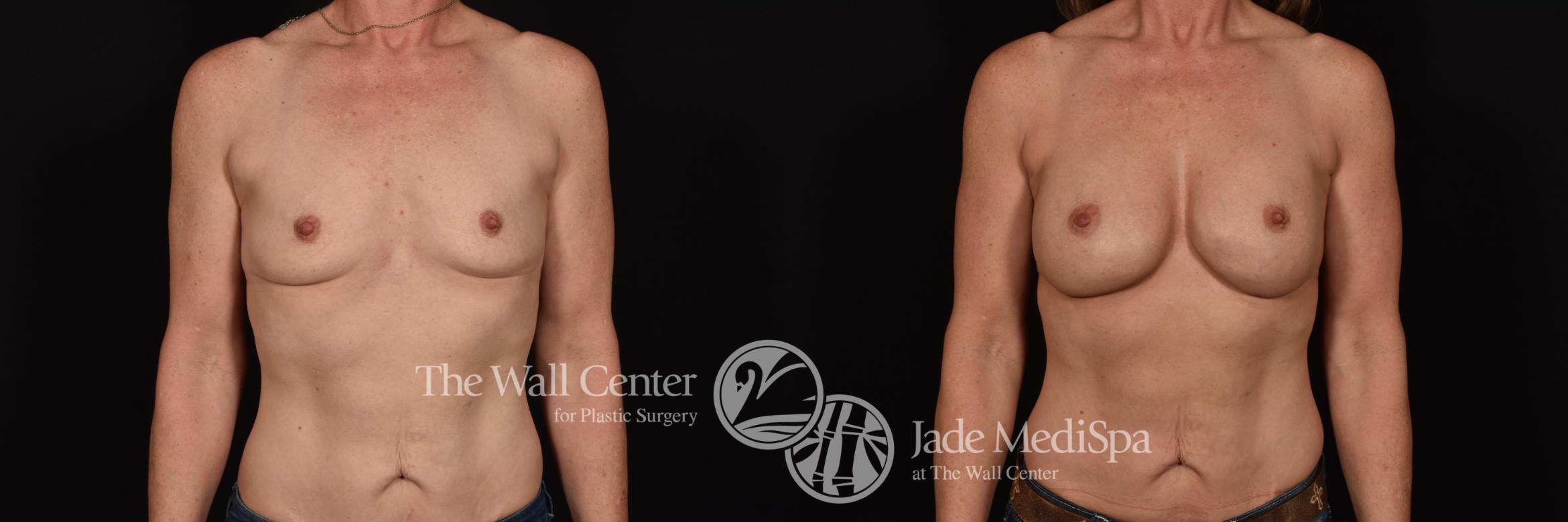 Before & After Breast Augmentation Case 1173 Front View in Shreveport, LA