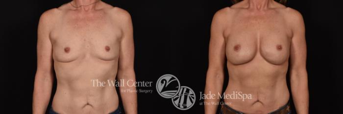 Before & After Breast Augmentation Case 1173 Front View in Shreveport, LA