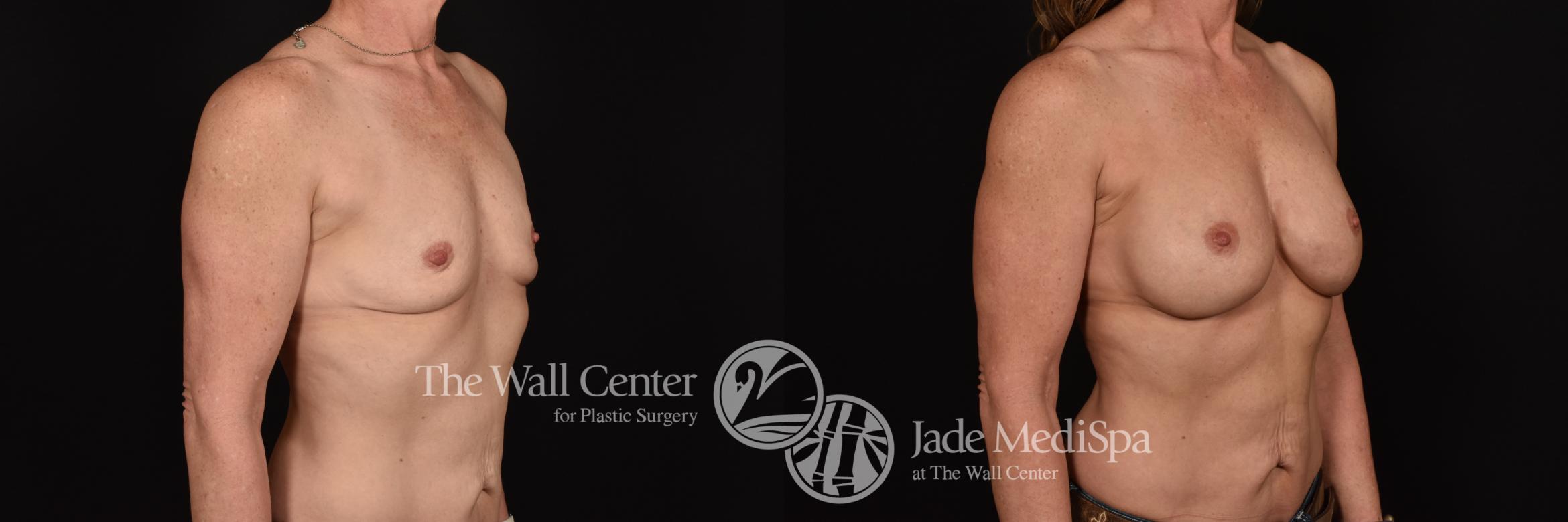 Before & After Breast Augmentation Case 1173 Right Oblique View in Shreveport, LA