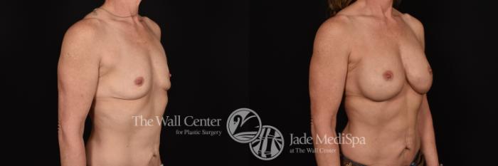 Before & After Breast Augmentation Case 1173 Right Oblique View in Shreveport, LA