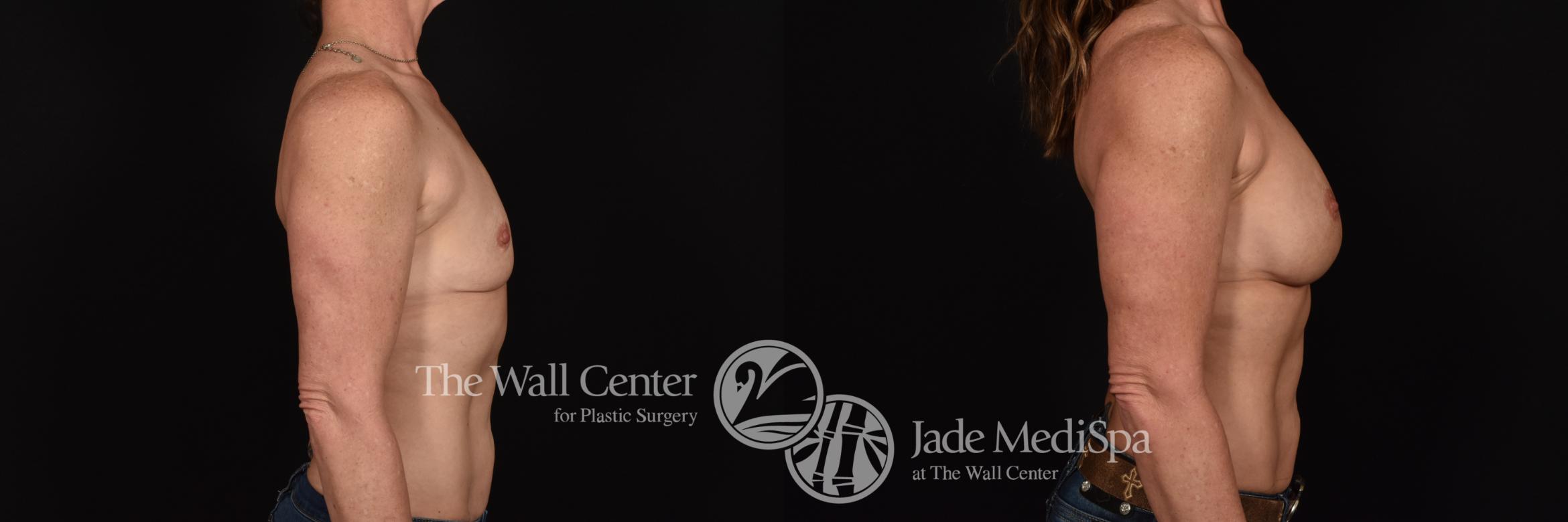Before & After Breast Augmentation Case 1173 Right Side View in Shreveport, LA