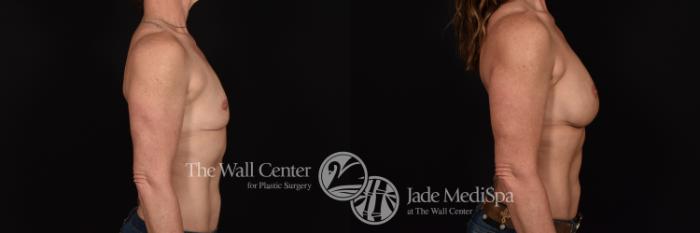 Before & After Breast Augmentation Case 1173 Right Side View in Shreveport, LA