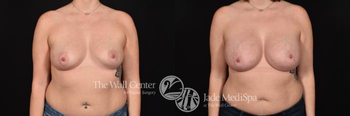 Before & After Breast Augmentation Case 1174 Front View in Shreveport, LA