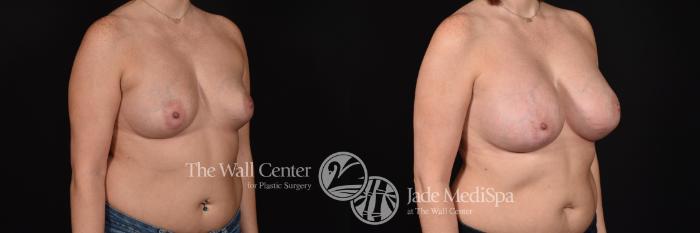 Before & After Breast Augmentation Case 1174 Right Oblique View in Shreveport, LA