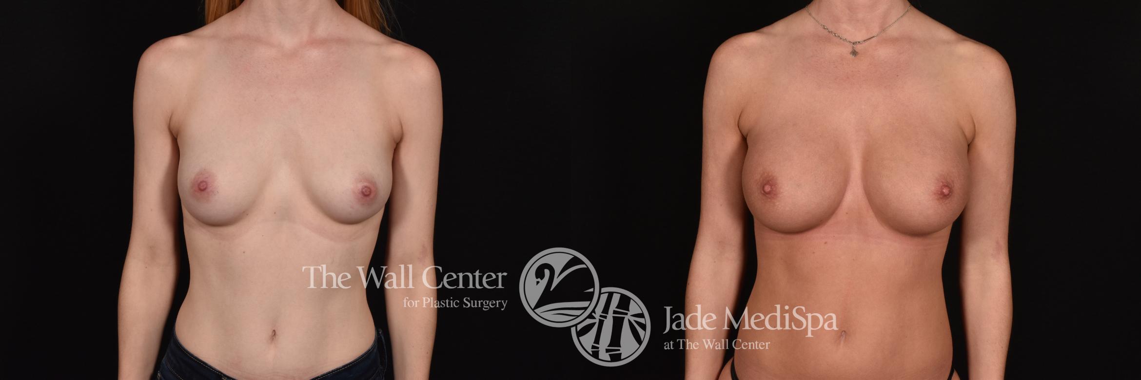 Before & After Breast Augmentation Case 1176 Front View in Shreveport, LA