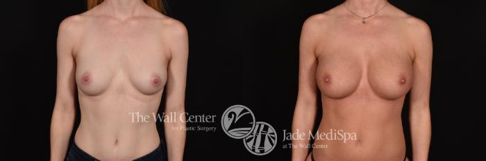 Before & After Breast Augmentation Case 1176 Front View in Shreveport, LA