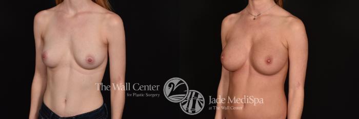 Before & After Breast Augmentation Case 1176 Left Oblique View in Shreveport, LA