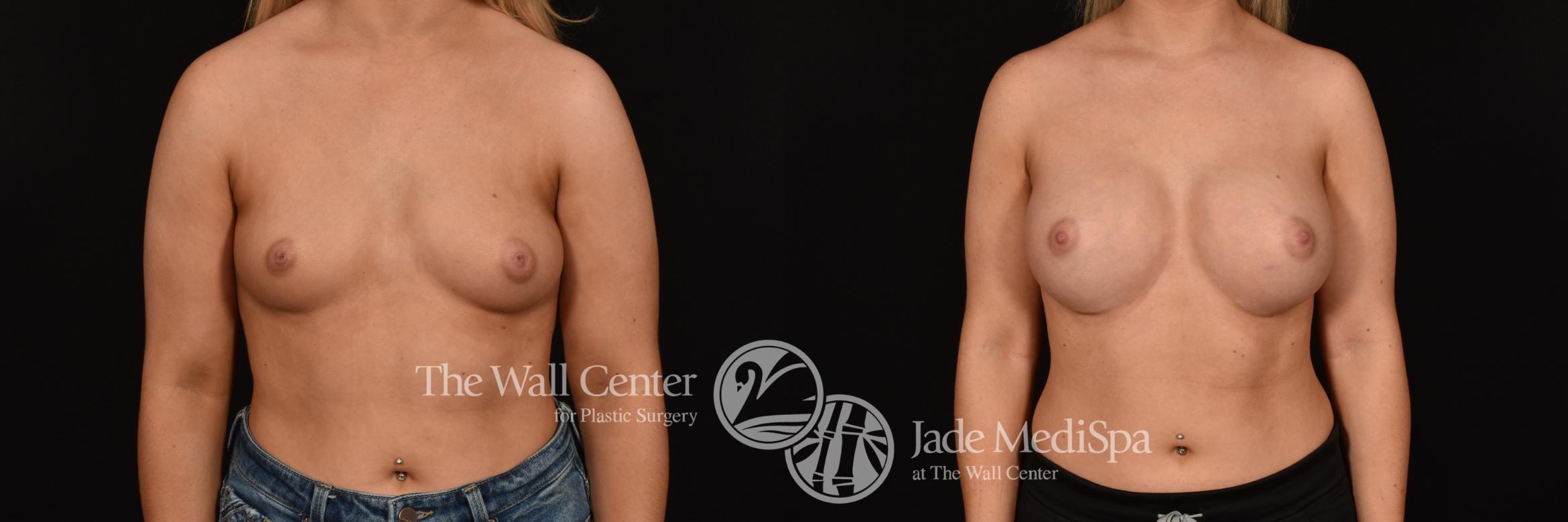 Before & After Breast Augmentation Case 1177 Front View in Shreveport, LA