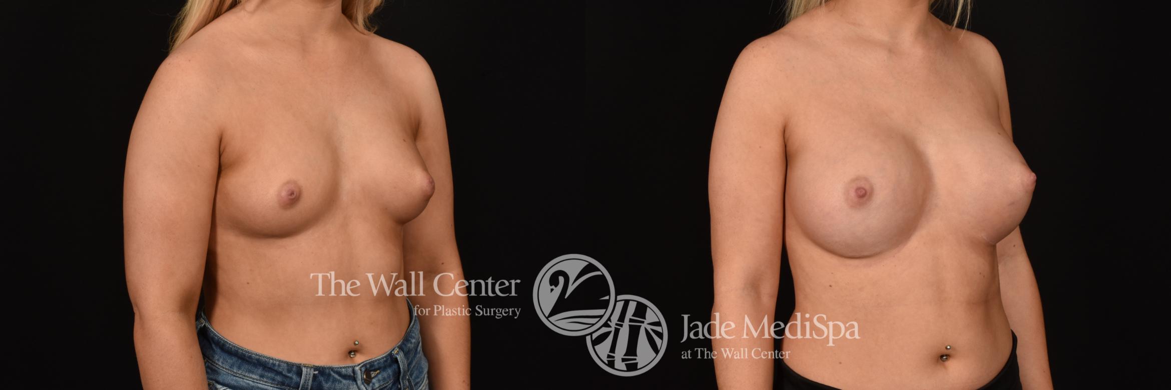 Before & After Breast Augmentation Case 1177 Right Oblique View in Shreveport, LA