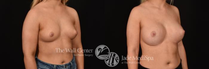 Before & After Breast Augmentation Case 1177 Right Oblique View in Shreveport, LA