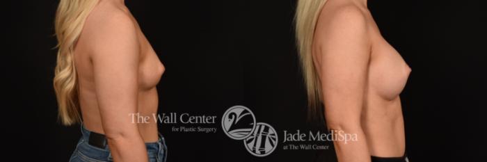 Before & After Breast Augmentation Case 1177 Right Side View in Shreveport, LA