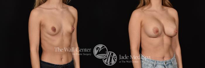 Before & After Breast Augmentation Case 1179 Right Oblique View in Shreveport, LA