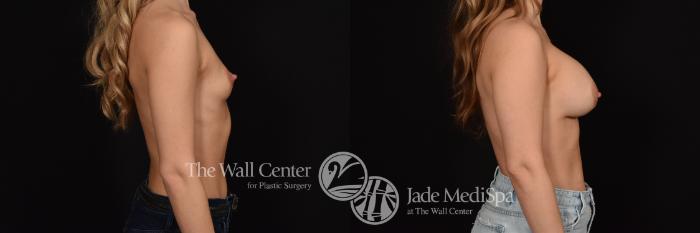 Before & After Breast Augmentation Case 1179 Right Side View in Shreveport, LA