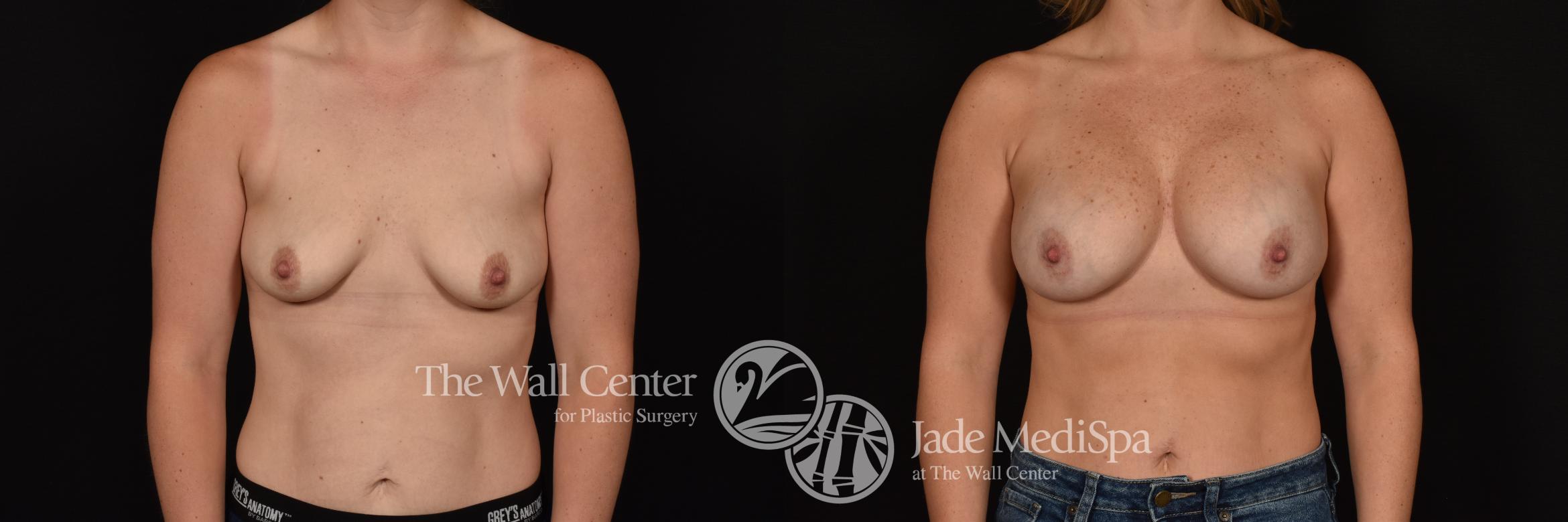 Before & After Breast Augmentation Case 1181 Front View in Shreveport, LA
