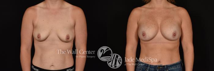 Before & After Breast Augmentation Case 1181 Front View in Shreveport, LA