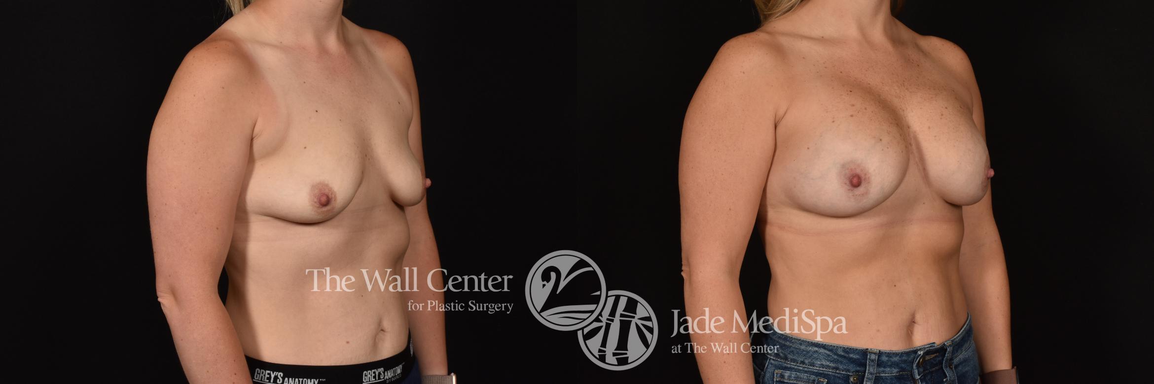 Before & After Breast Augmentation Case 1181 Right Oblique View in Shreveport, LA