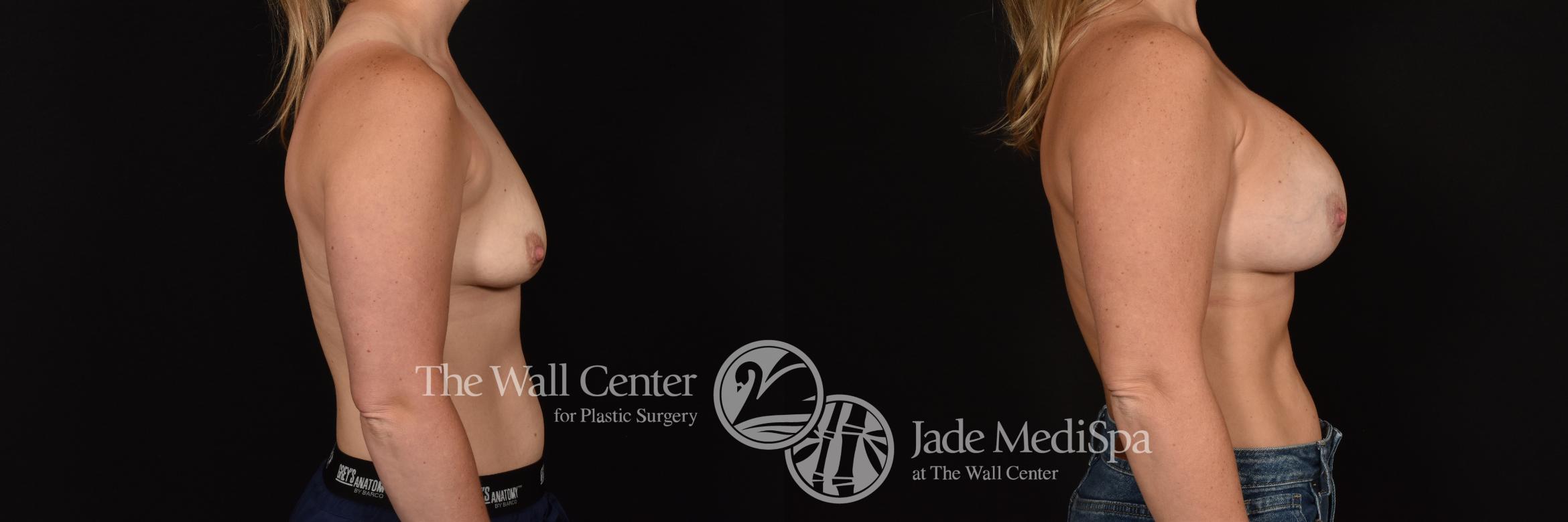 Before & After Breast Augmentation Case 1181 Right Side View in Shreveport, LA