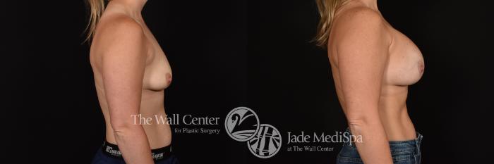 Before & After Breast Augmentation Case 1181 Right Side View in Shreveport, LA