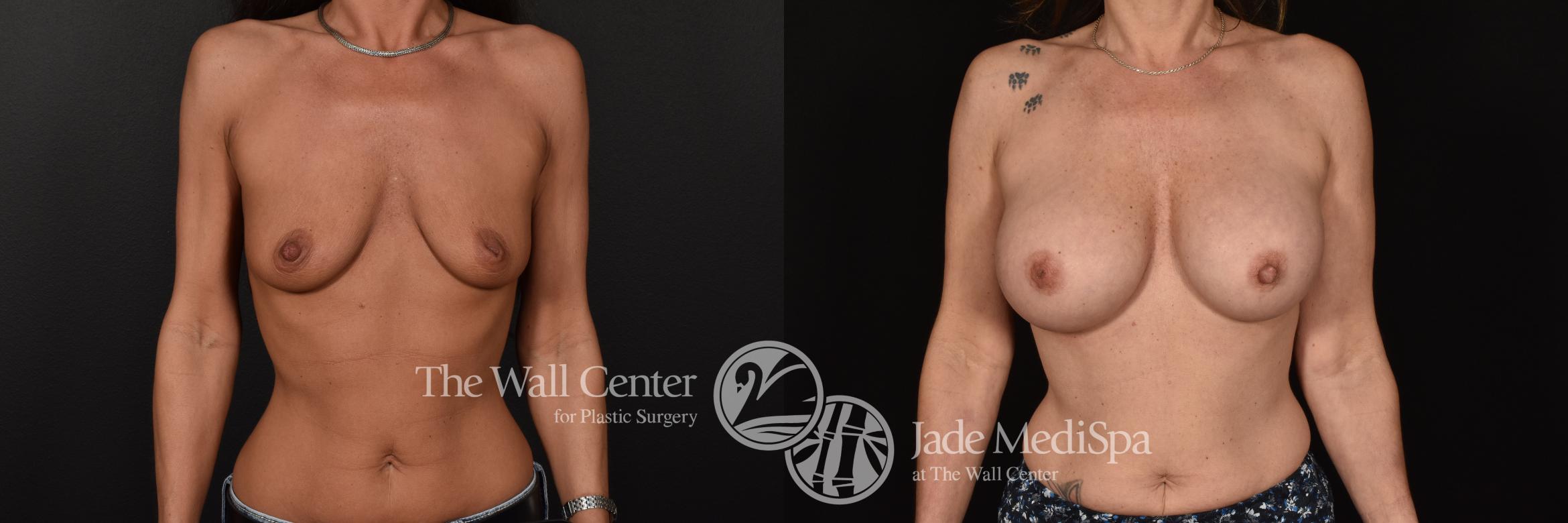 Before & After Breast Augmentation Case 1183 Front View in Shreveport, LA