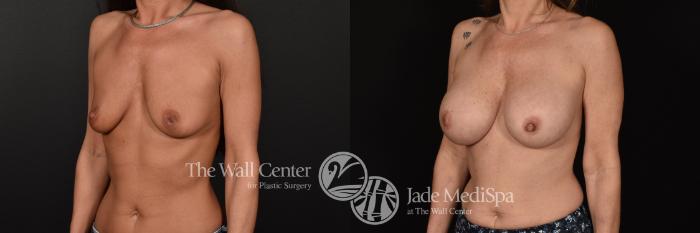 Before & After Breast Augmentation Case 1183 Left Oblique View in Shreveport, LA